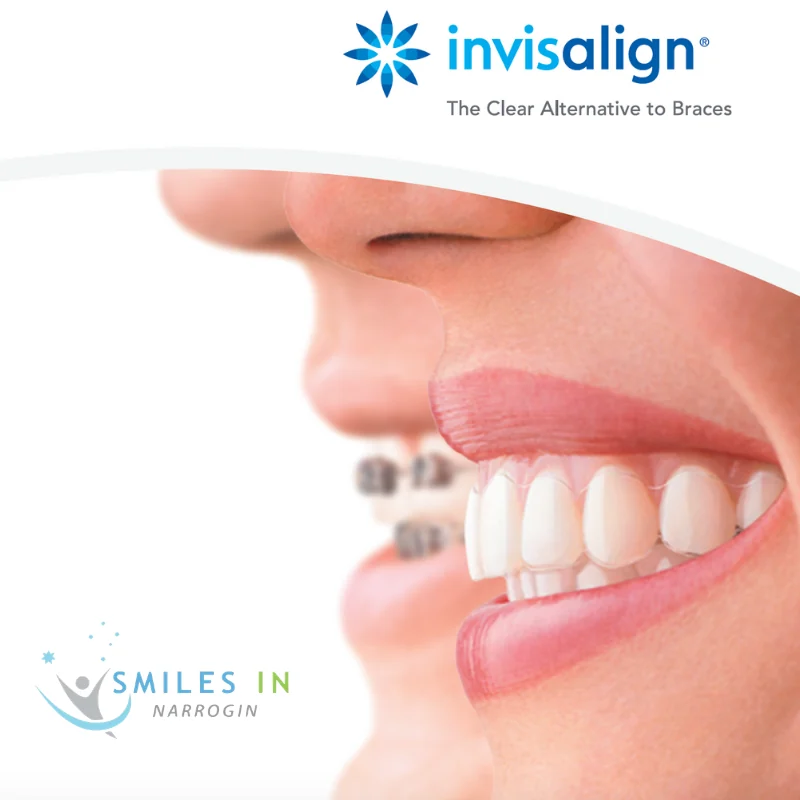 Invisalign — the clear alternative to braces, available at Smiles in Narrogin